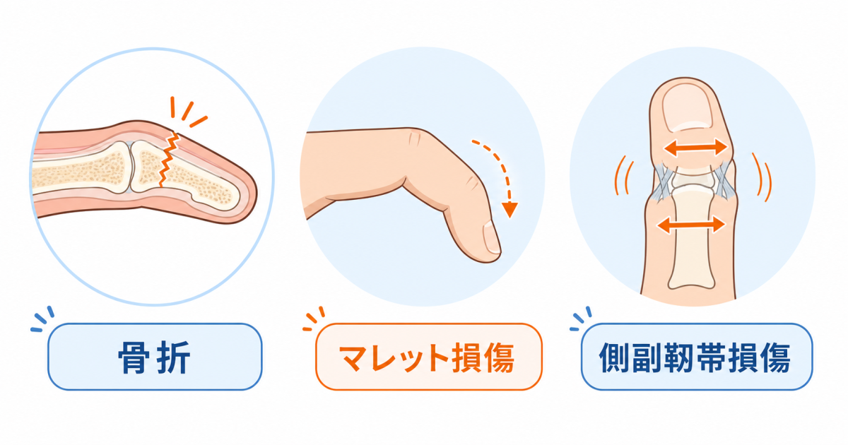■突き指が「治らない」「曲げると痛い」ときに疑われる3つの疾患